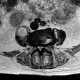 Spondylodiscitis, abscess of psoas muscle, drainage of abscess: MRI - Magnetic Resonance Imaging